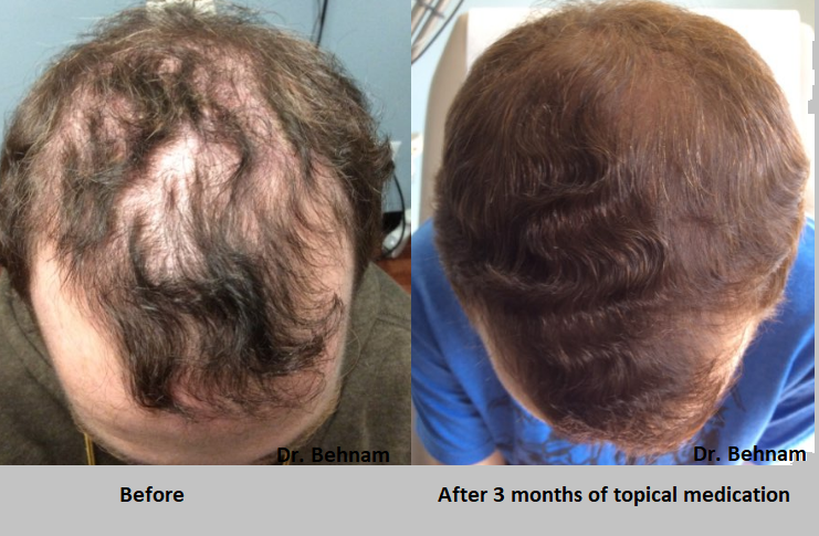 1 month finasteride results