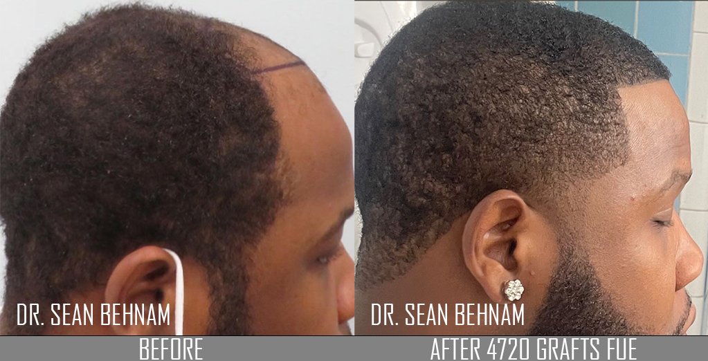 Men S African American Hair Transplant Dr Sean Behnam