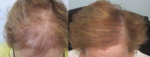 Before and after 1,862 grafts placed at the hairline and midscalp.By Dr Sean Bhenam
