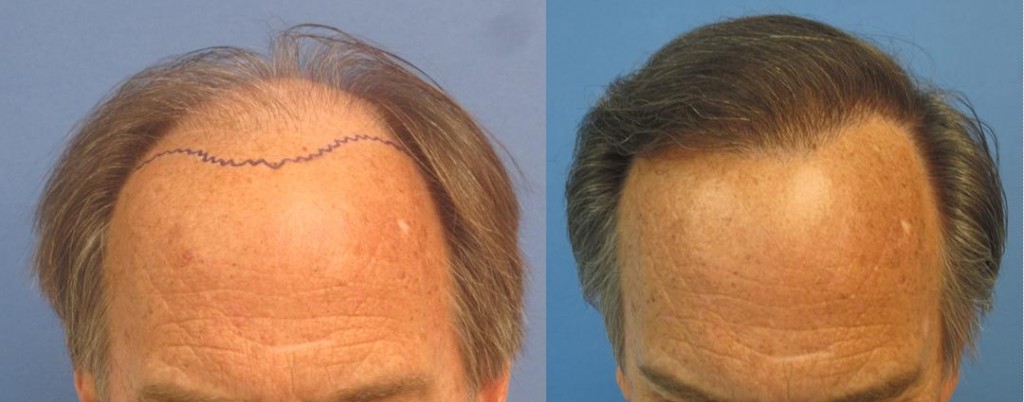 Before and after 2,256 grafts placed in one session. Class 6. 