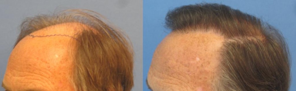 Before and after 2,256 grafts. Class 6. Side view. Notice how natural the hair transplant looks. By Dr Sean Behnam.