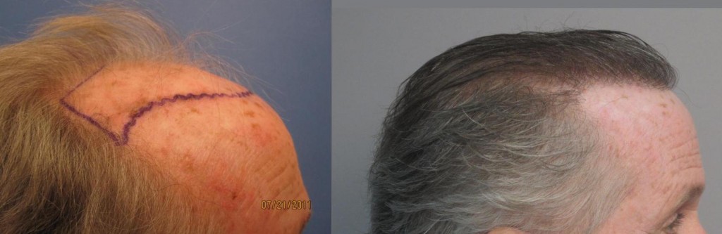  2,135 grafts placed in the hairline and the midscalp. Side view. Please notice how natural and dense the hairline looks. Class 6. By Dr. Sean Behnam.