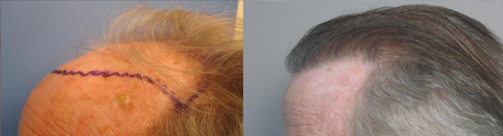  2,135 grafts placed in the hairline and the midscalp. Side view. Please notice how natural the hairline looks. Class 6. By Dr. Sean Behnam.