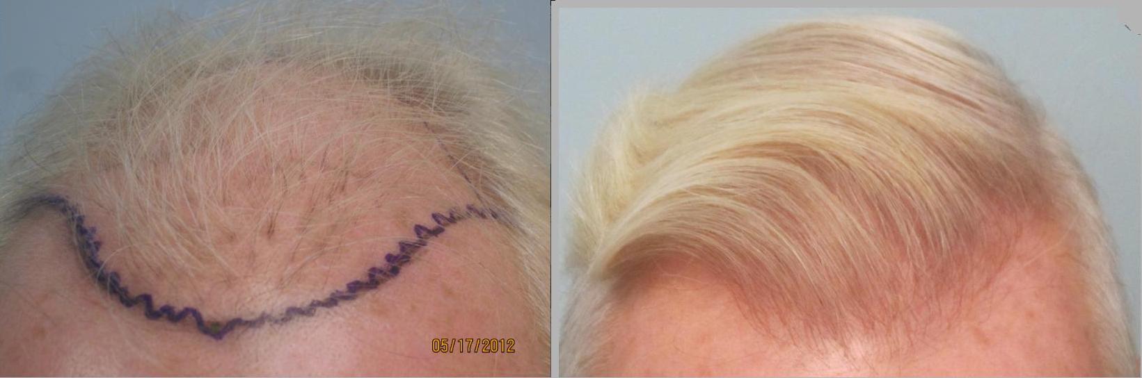 2,608 grafts placed from the frontal hairline till midscalp. Front closeup view. Patient had a prior hair transplant that looked pluggy and sparse and was repaired by Dr Sean Behnam. Please notice how natural and thick the hairline looks.