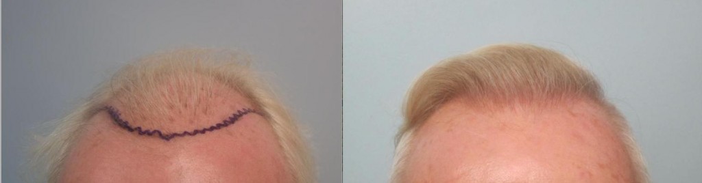 2,608 grafts placed from the frontal hairline till midscalp. Front view. Patient had a prior hair transplant that looked pluggy and sparse and was repaired by Dr Sean Behnam. Please notice how natural and thick the hairline looks. 