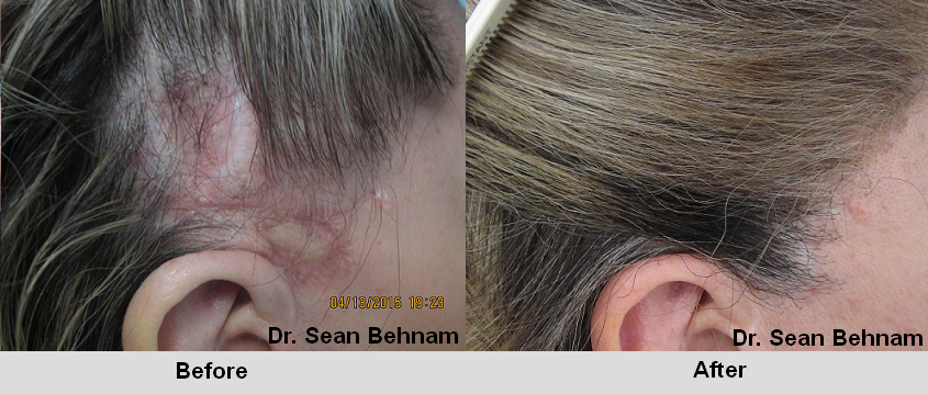 Women S Hair Transplant Before After Pictures Dr Sean Behnam