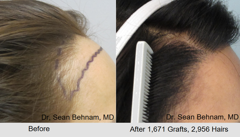 Women hair transplant