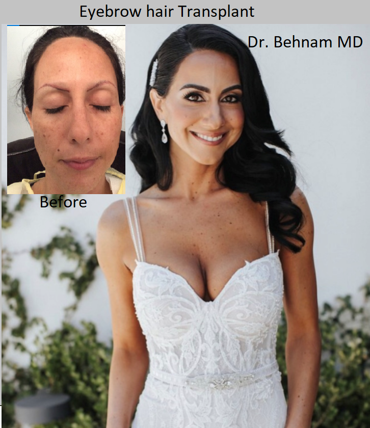 Eyebrow Hair Transplant surgery performed by Dr. Behnam