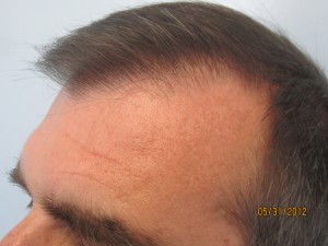 The entire hairline is transplanted. Please notice how natural it looks. All single hair follicles are placed in the frontal hairline followed by two and three hair follicle behind it. No one would notice that the entire hairline is transplanted.