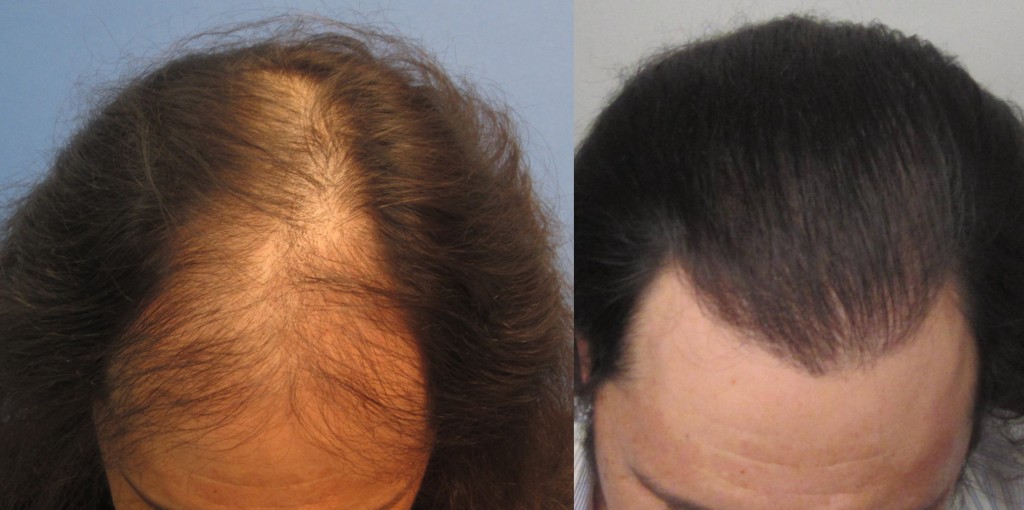 1634 grafts placed at the hairline and midscalp. Top view. By Dr Sean Behnam 