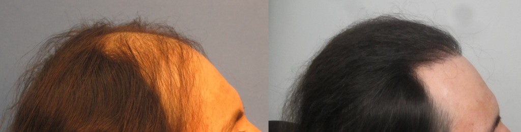 1634 grafts placed at the hairline and midscalp. Side view. By Dr Sean Behnam 