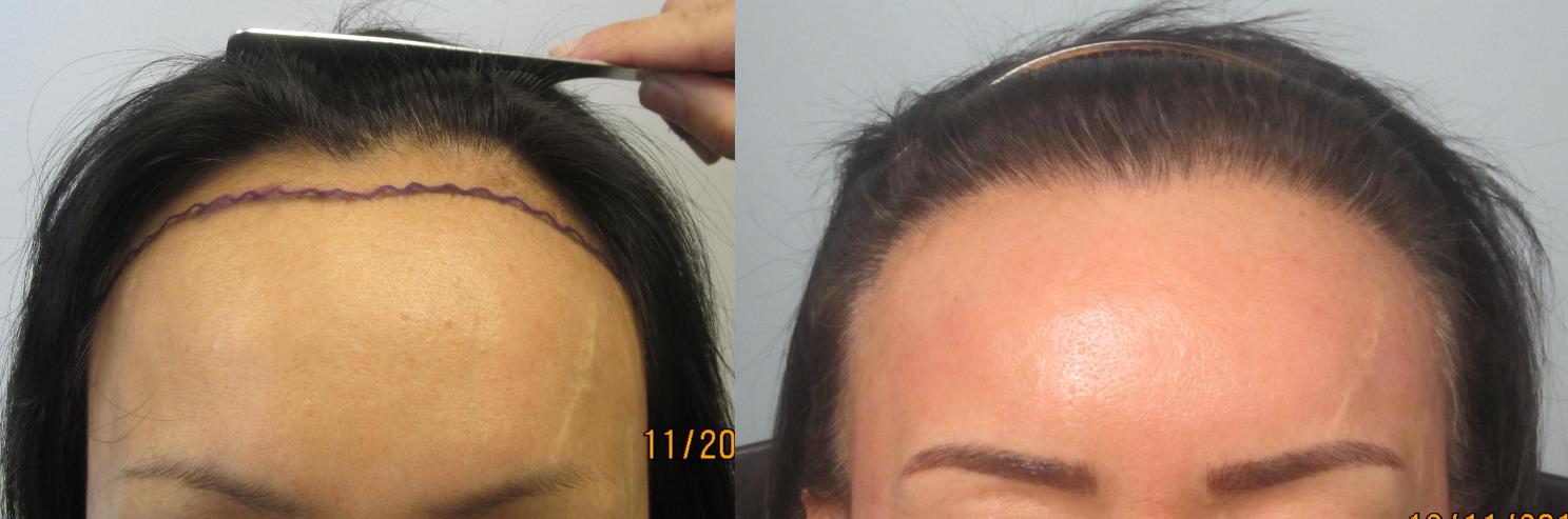 Women's Hair Transplant Before & After Pictures - Dr. Sean Behnam