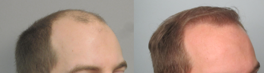 Men's Hair Transplant Before & After Pictures - Dr. Sean Behnam MD