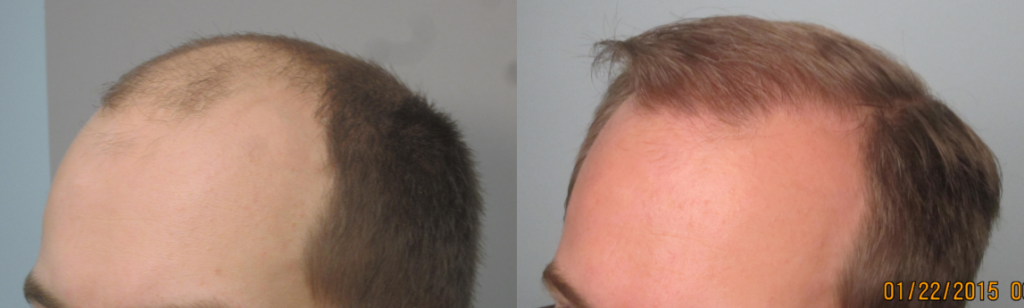 2,247 Grafts placed at athe hairline and midscalp in one session. Results demonstarte greater than 95% graft survival. By Dr Sean Behnam MD