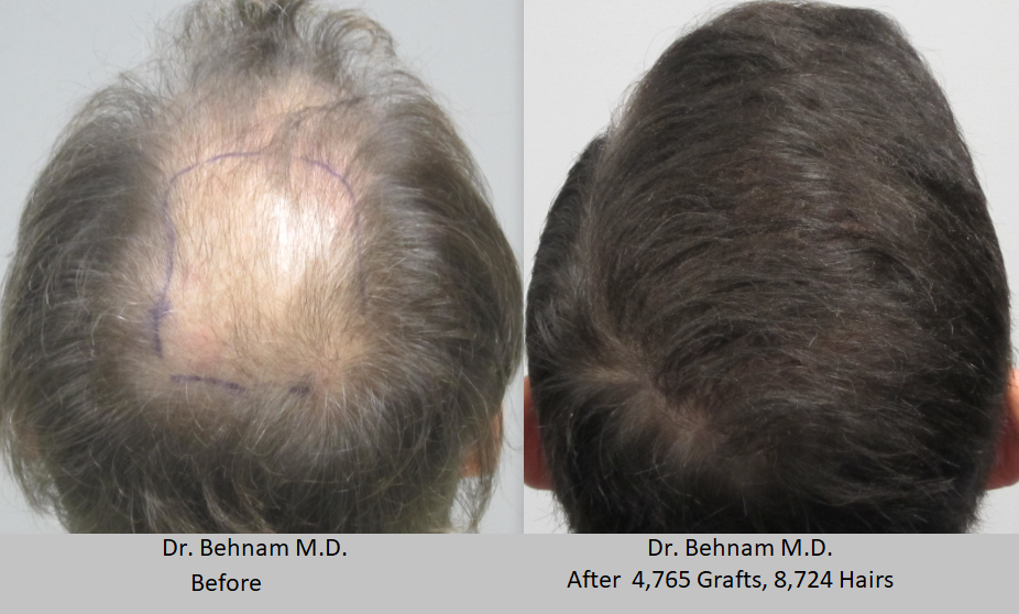 Man before and after hair restoration