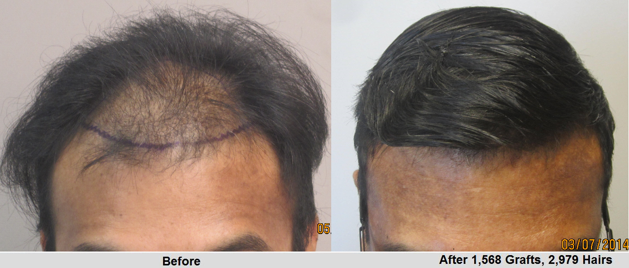 Before and after 1500 hair grafts