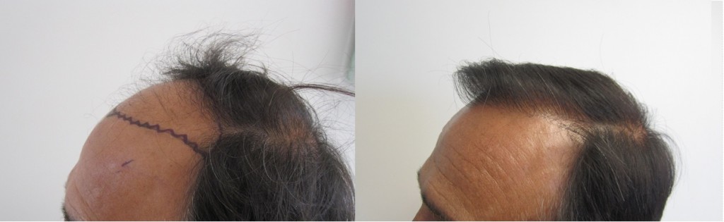 Class 4. Left Side view. 2,000 grafts. One session only. Please pay attention to how natural the hairline is. hair transplant is an art, especially the hairline creation.