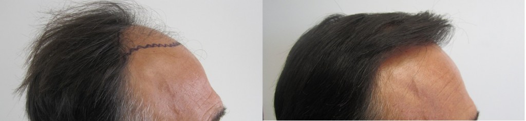 Class 4. Right side view. Before and after 2,000 grafts. 