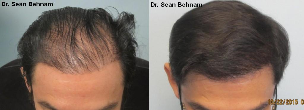 Top view: After 2,054 grafts placed by FUE method. Procedure performed by Dr. Sean Behnam. Increased density achieved after one session of FUE.