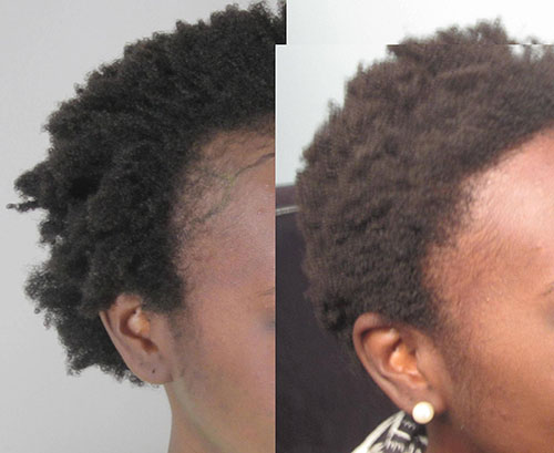 Before and after 1,465 grafts placed at the hairline and temples. Procedure performed by Dr. Sean Behnam.