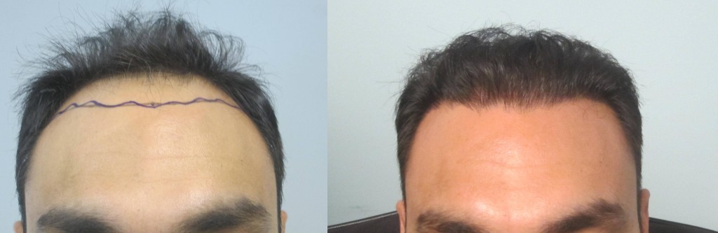 This gentleman had 2,045 grafts placed in the hairline and midscalp. Results are after one procedure. Procedure performed by Dr. Sean Behnam.