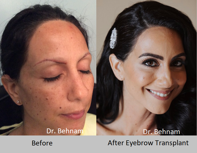 Eyebrow Hair Transplant surgery performed by Dr. Behnam