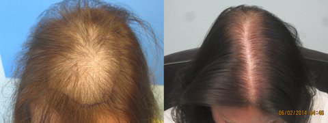 before-hair-transplant-los-angeles