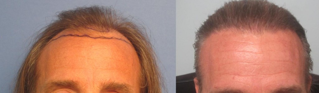 2,145 grafts placed at the hairline and midscalp. front view. By Dr Sean Behnam. 