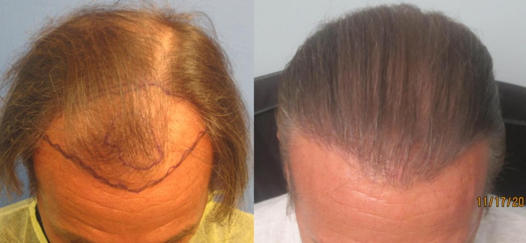 2,145 grafts placed at the hairline and midscalp. Top view. By Dr Sean Behnam. 