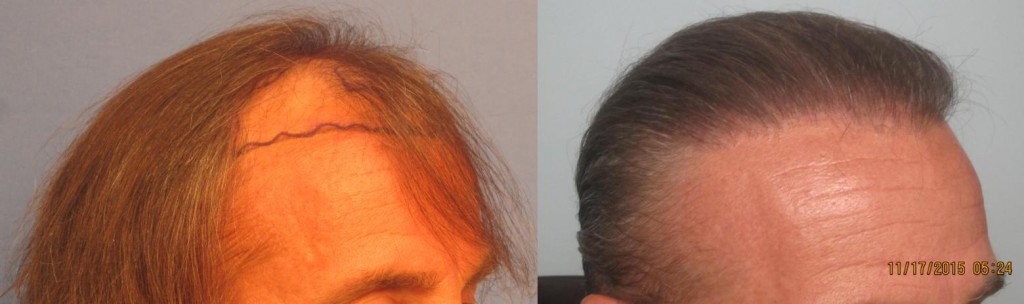 2,145 grafts placed at the hairline and midscalp. Side view. By Dr Sean Behnam. 