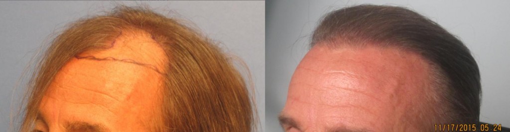 2,145 grafts placed at the hairline and midscalp. Side view. By Dr Sean Behnam. 