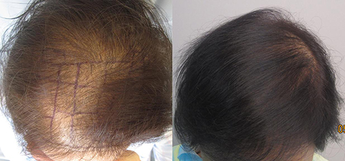 This women had 1,560 grafts placed in one session. By Dr. Sean Behnam. Left picture is before the procedure and the right picture is one year after.