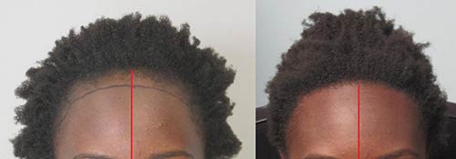 Before and after grafts to repalce area lost by traction alopecia.Dr. behanm is an expert in ethnic hair transplant .