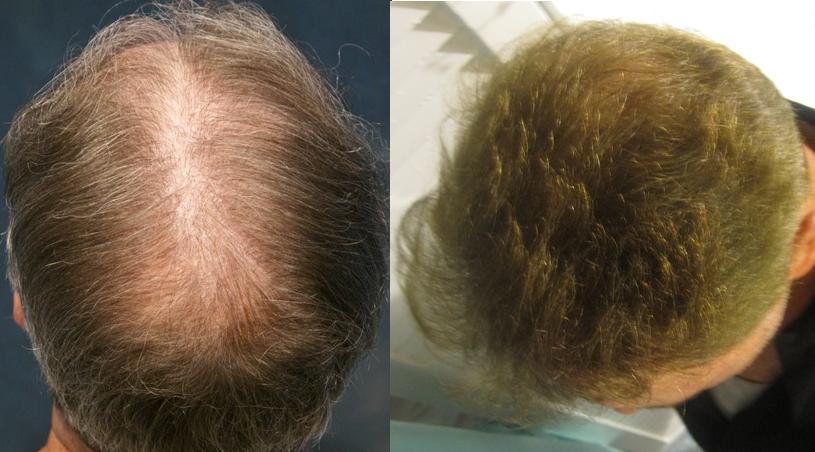 Hair transplant restoration Los Angeles