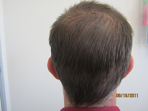 hair-transplant-los-angeles