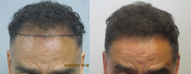 African American FUE hair transplant: This gentleman had 1,232 grafts placed int he frontal hairline. This procedure was performed by the FUE method, where individual grafts were removed one by one and placed int he frontal hairline. Los Angeles hair transplant dr. Sean Behnam 