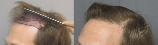 Class 3, thinning. This gentleman had 1,749 grafts placed in the hairline. The left picture shows how thinned the frontal hairline is before the hair transplant. The picture to the right shows how thicker the hairline is after the procedure.