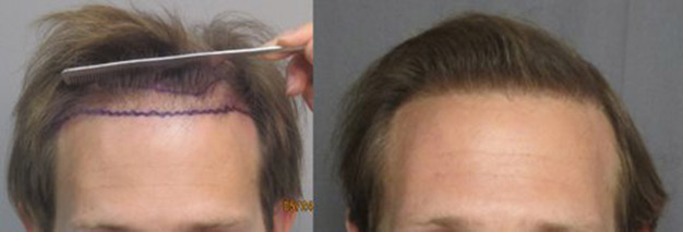 Class 3, thinning. This gentleman had 1,749 grafts placed in the hairline. The left picture shows how thinned the frontal hairline is before the hair transplant. The picture to the right shows how thicker the hairline is after the procedure. hair-transplant-los-angeles