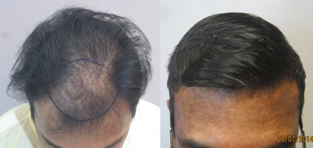 Class 3 thinning: Before and after 1,568 grafts placed in the hairline. Procedure performed by Dr. Sean Behnam MD. hair-transplant-los-angeles4