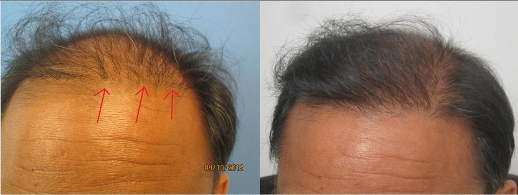 Hair transplant Los Angeles