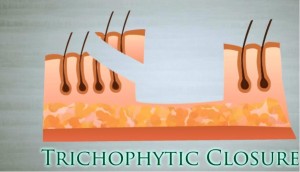 strip hair transplant trichophytic closure