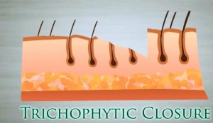 strip hair transplant trichophytic closure