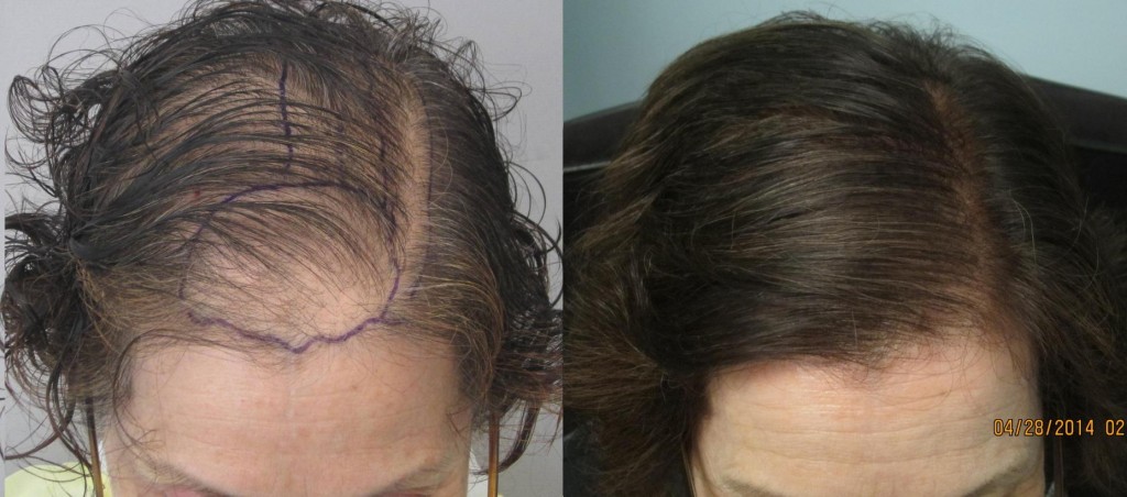 Woman before and after hair transplant