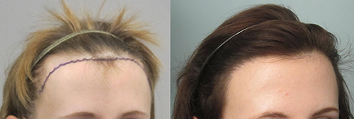 Female hair transplant before and after pics