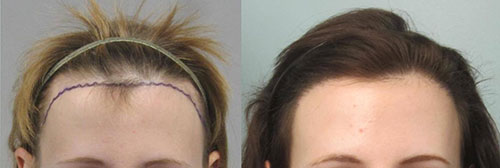 womens-hair-transplant-los-angeles2