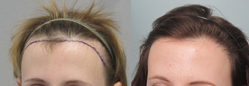 womens-hair-transplant-los-angeles3