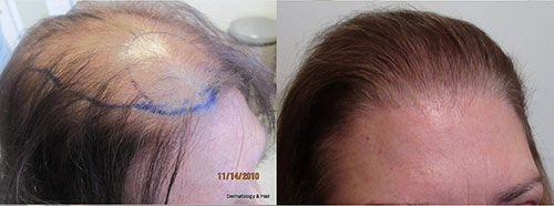 This women had 1830 grafts placed in one session. Procedure performed by Dr. Sean Behnam. This woman had ludwig class 3 hair loss.