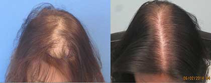 Woman before and after hair transplant