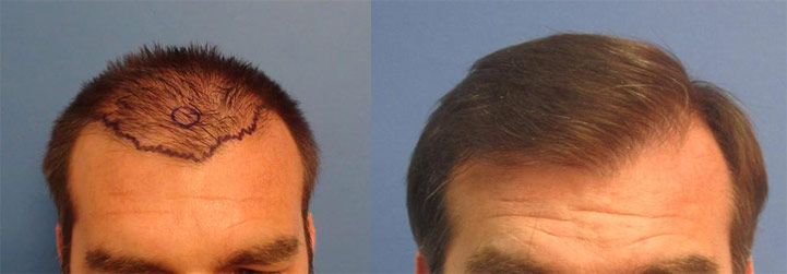 hair transplant in los angeles