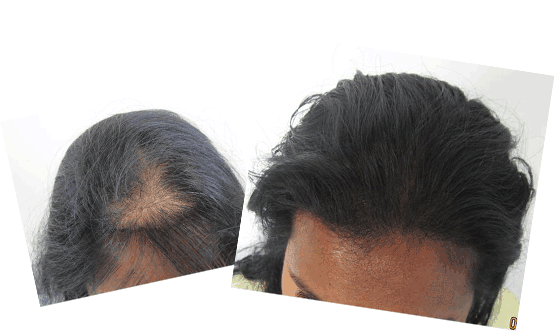 Mild hair loss in the frontal area. Ludwig class 1. About 1,000 grafts were added to the area